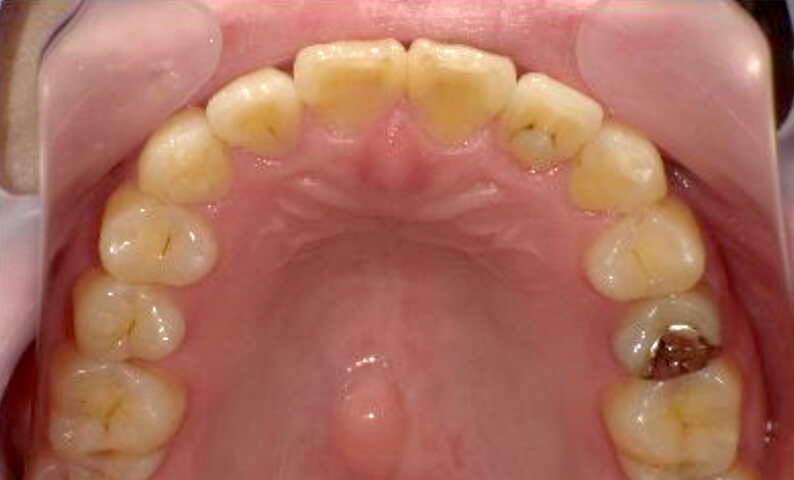 部分矯正 40代の症例写真