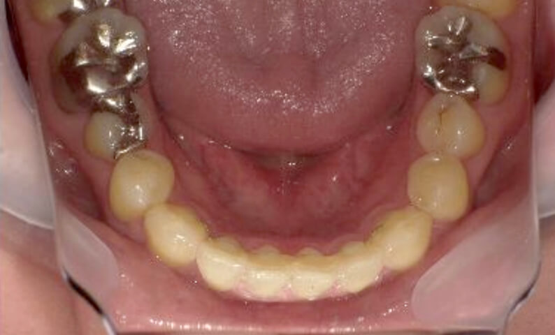 部分矯正 40代の症例写真