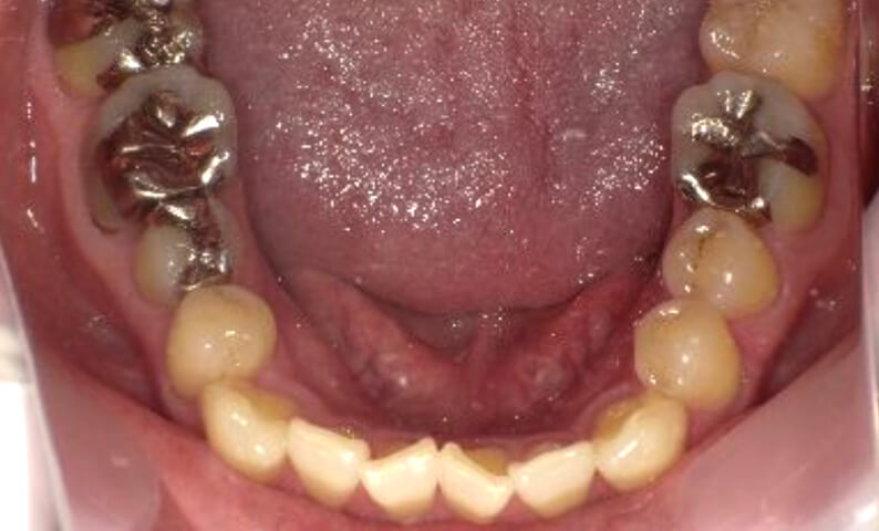 部分矯正 40代の症例写真