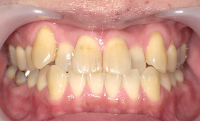 部分矯正 40代の症例写真