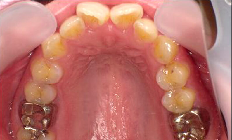 部分矯正 40代の症例写真