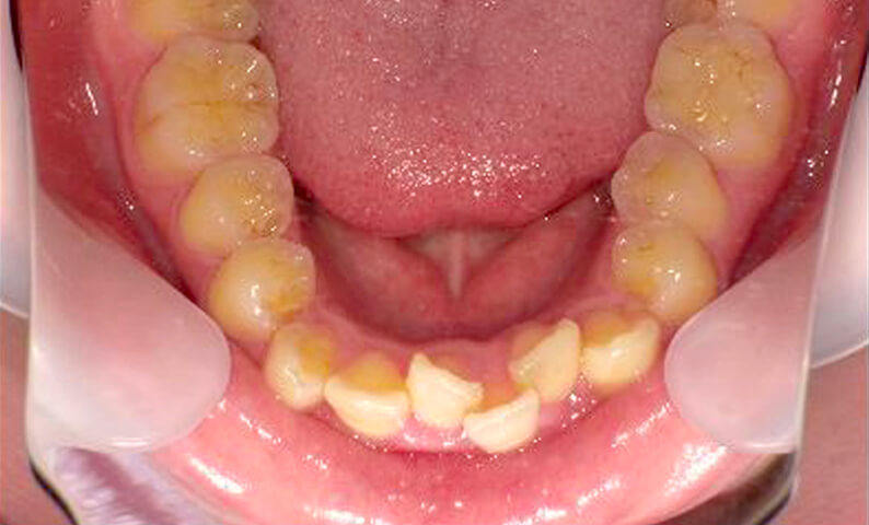 部分矯正 40代の症例写真