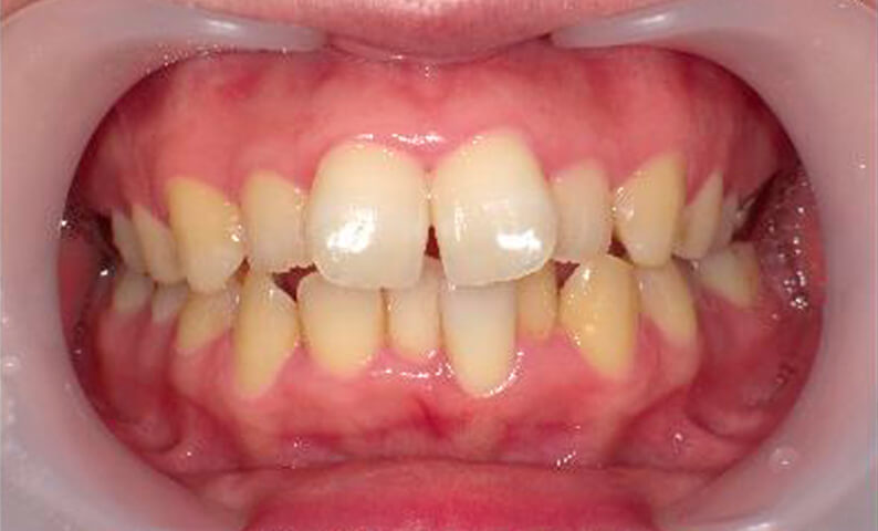 部分矯正 40代の症例写真