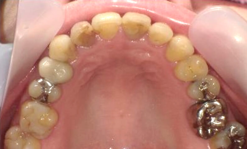 部分矯正 40代の症例写真