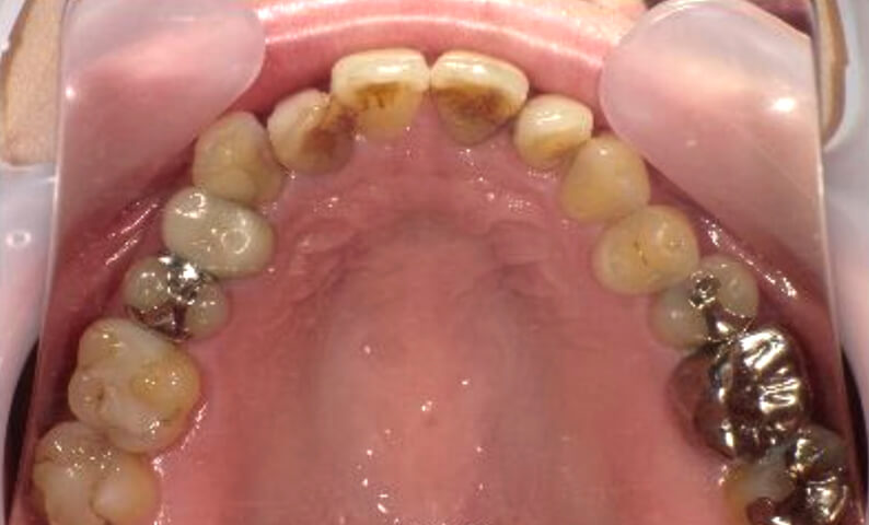 部分矯正 40代の症例写真