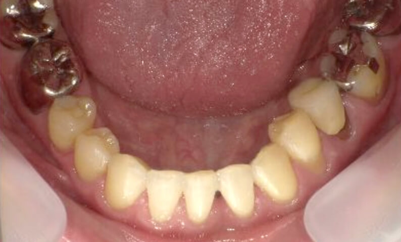 部分矯正 40代の症例写真