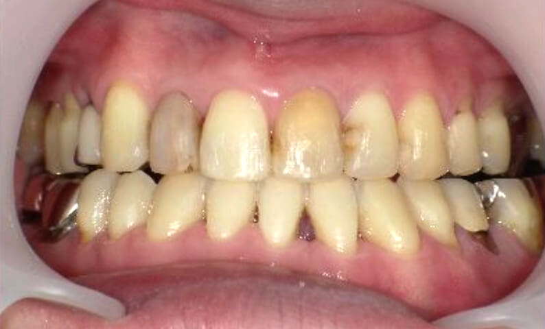 部分矯正 40代の症例写真