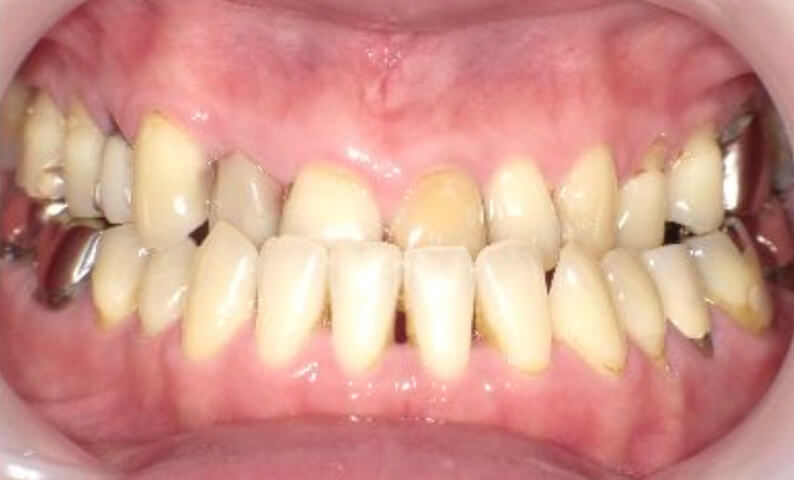 部分矯正 40代の症例写真