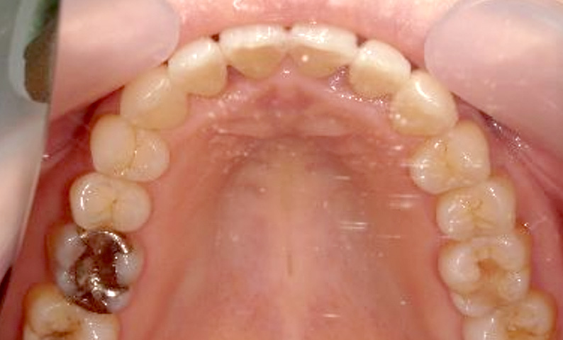 部分矯正 40代の症例写真