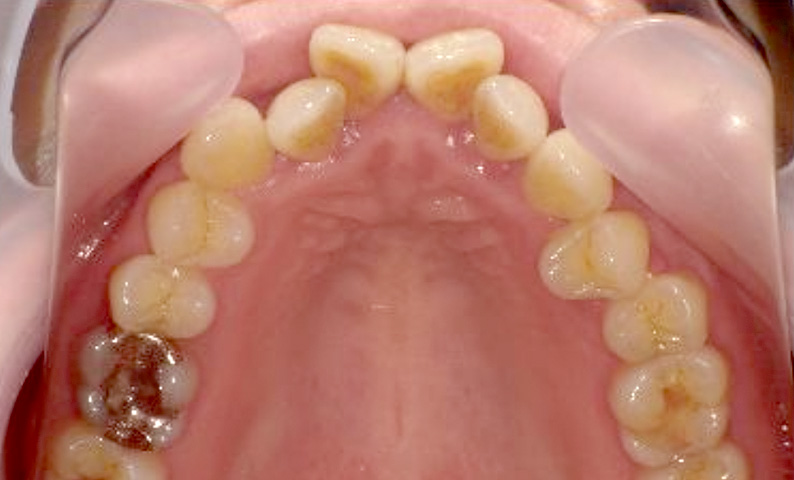 部分矯正 40代の症例写真