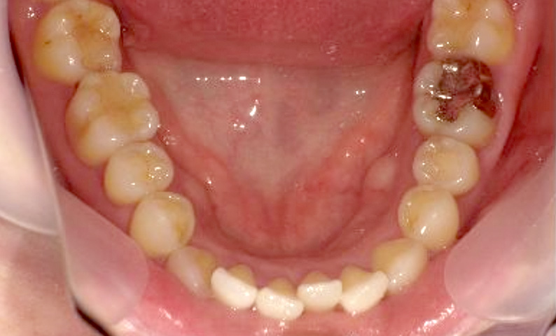 部分矯正 40代の症例写真