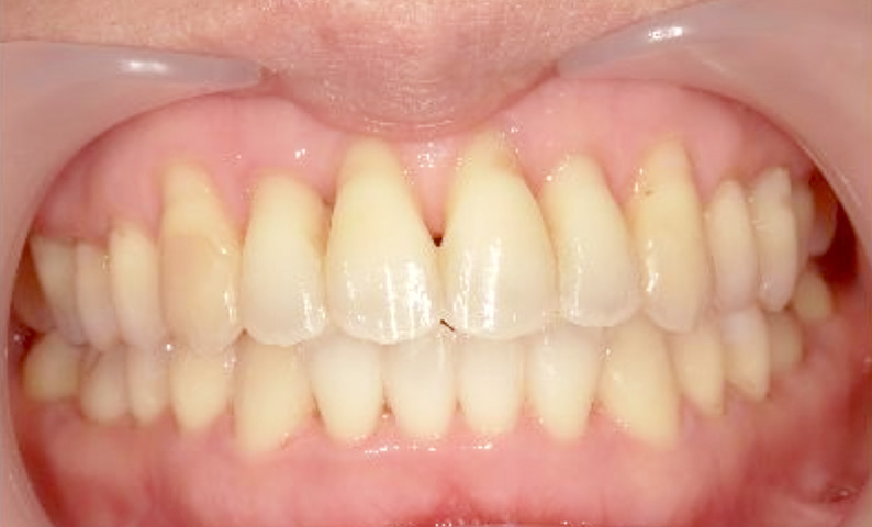 部分矯正 40代の症例写真