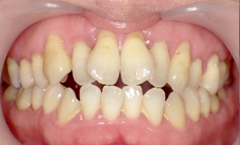 部分矯正 40代の症例写真