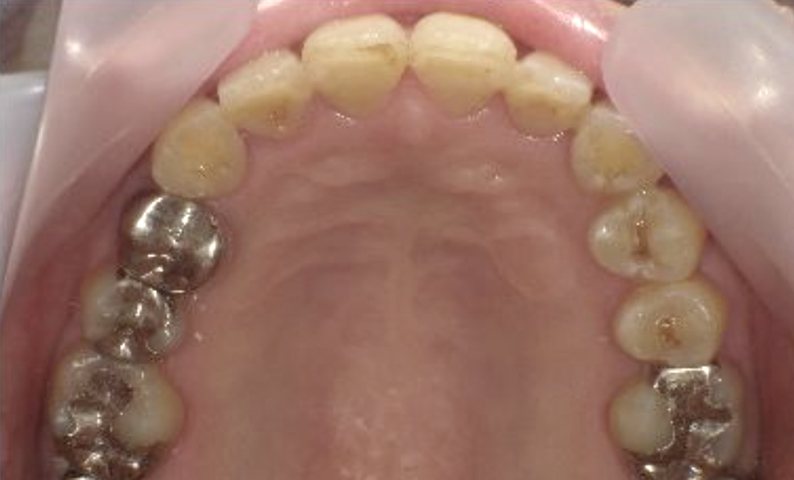 部分矯正 40代の症例写真