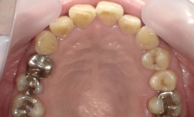 部分矯正 40代の症例写真