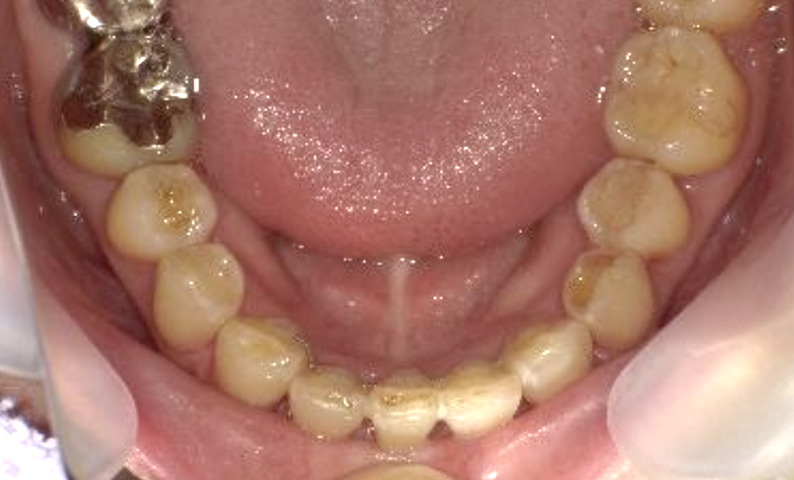 部分矯正 40代の症例写真