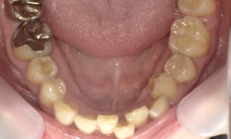 部分矯正 40代の症例写真