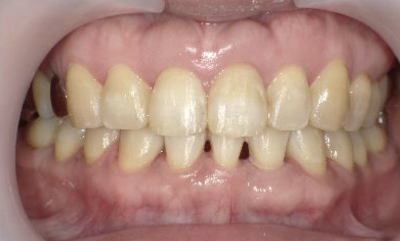 部分矯正 40代の症例写真