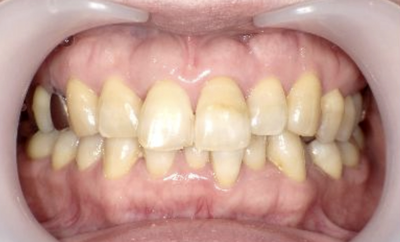 部分矯正 40代の症例写真