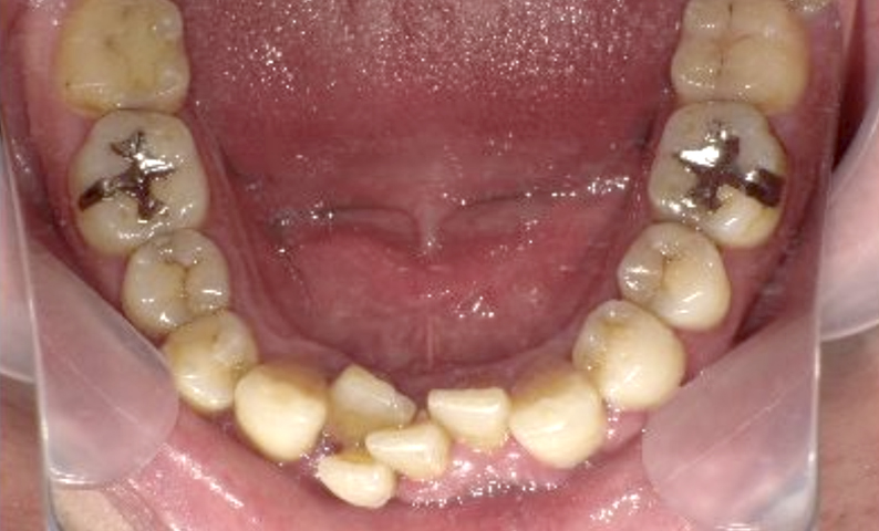 部分矯正 40代の症例写真