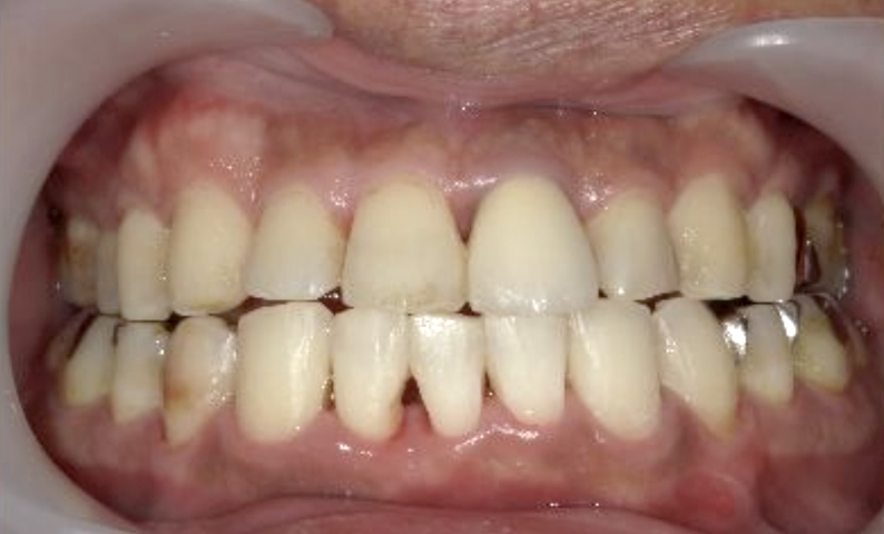 部分矯正 40代の症例写真