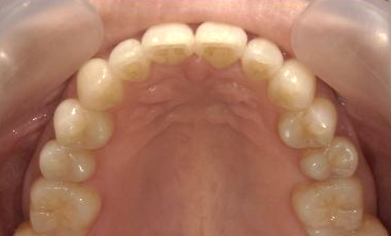 部分矯正 40代の症例写真