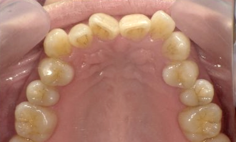 部分矯正 40代の症例写真