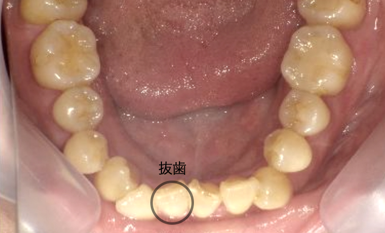 部分矯正 40代の症例写真
