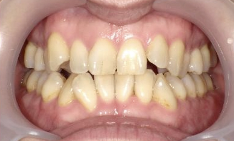 部分矯正 40代の症例写真