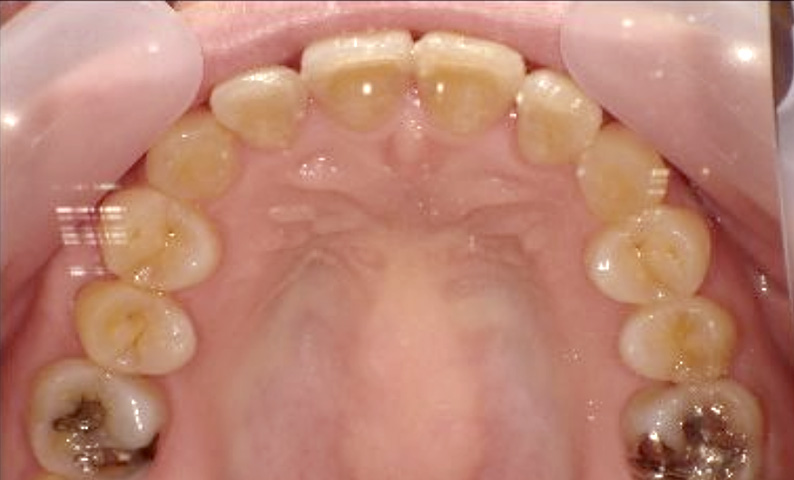 部分矯正 40代の症例写真