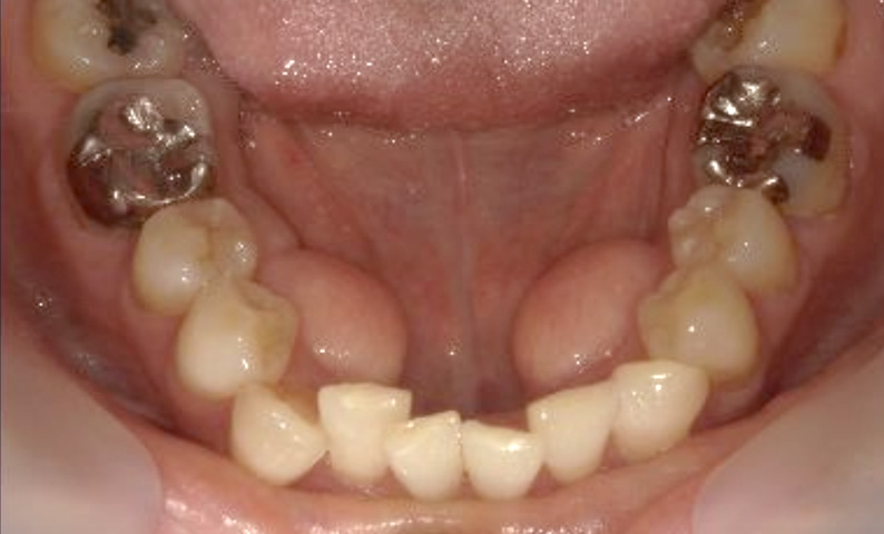 部分矯正 40代の症例写真