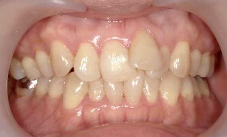 部分矯正 40代の症例写真