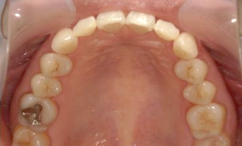 部分矯正 40代の症例写真