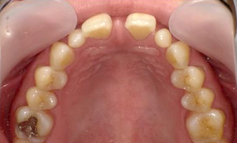 部分矯正 40代の症例写真