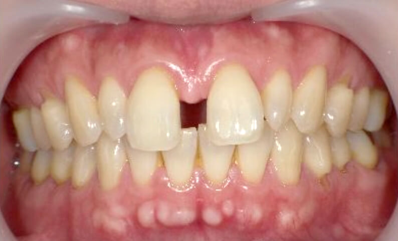 部分矯正の症例 すきっ歯