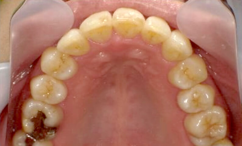 部分矯正 40代の症例写真