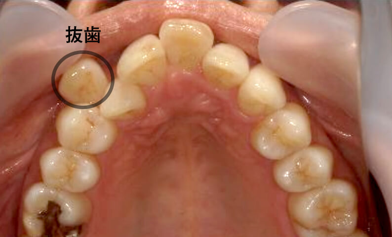 部分矯正 40代の症例写真