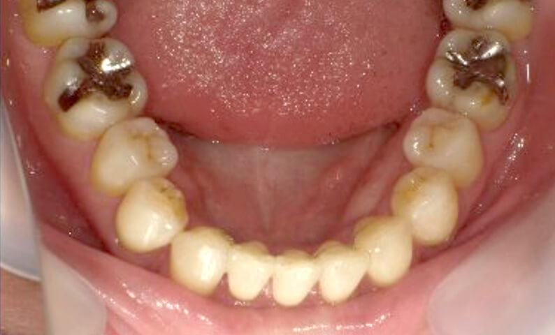 部分矯正 40代の症例写真