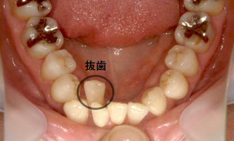 部分矯正 40代の症例写真