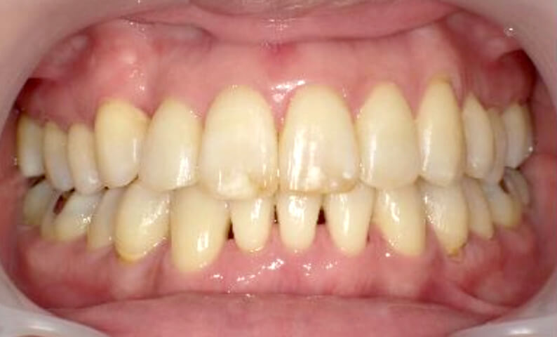 部分矯正 40代の症例写真