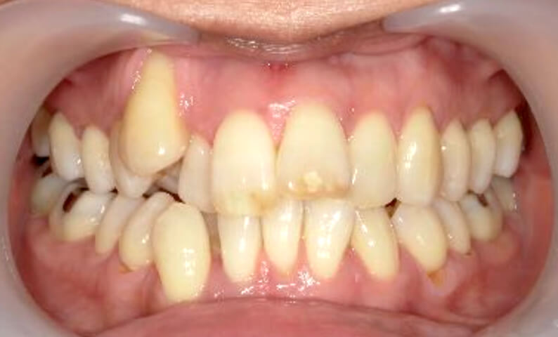 部分矯正 40代の症例写真