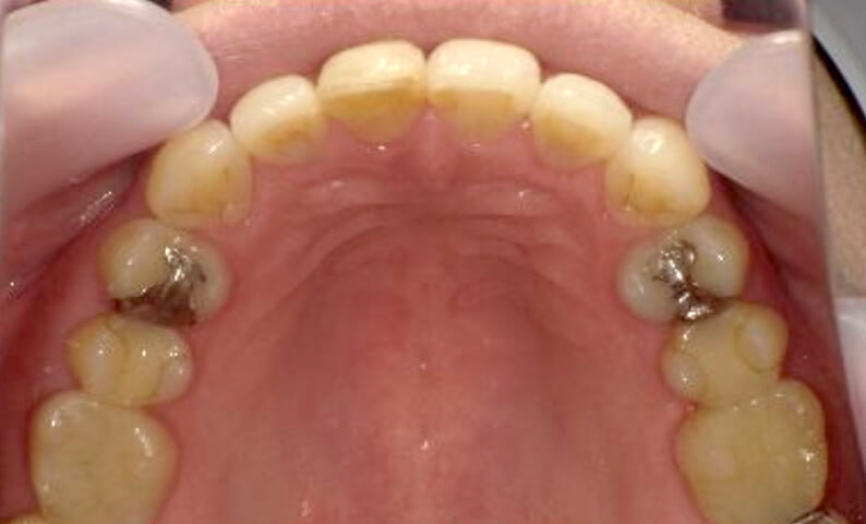 部分矯正 40代の症例写真