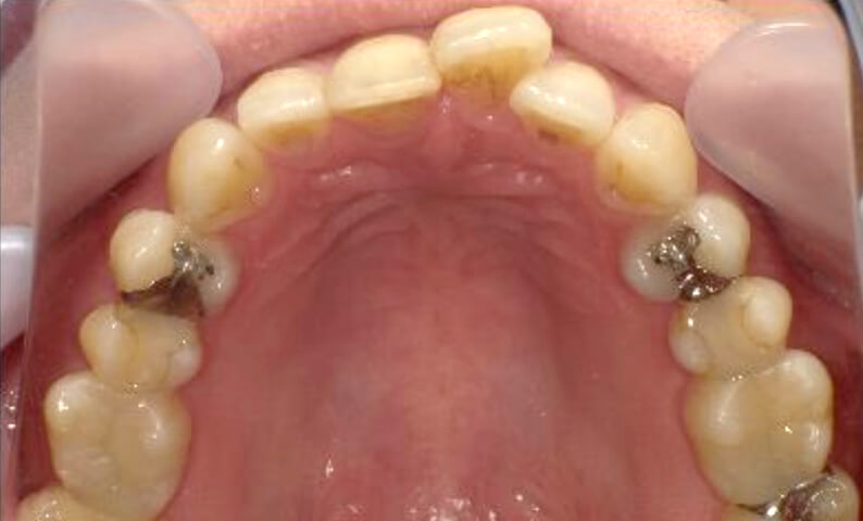 部分矯正 40代の症例写真