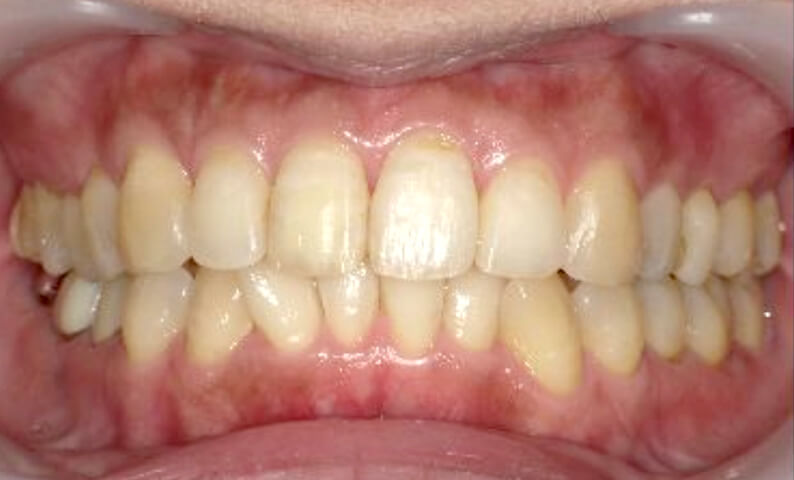 部分矯正 40代の症例写真