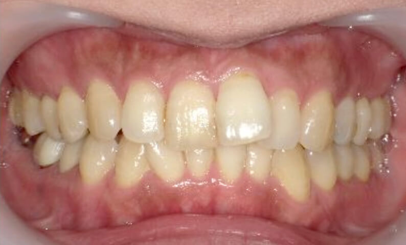 部分矯正 40代の症例写真