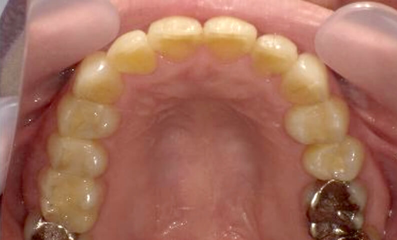 部分矯正 40代の症例写真