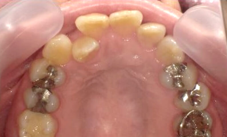 部分矯正 40代の症例写真