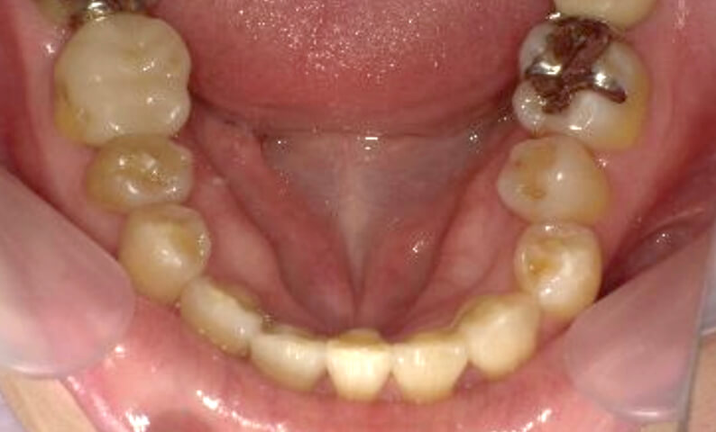 部分矯正 40代の症例写真