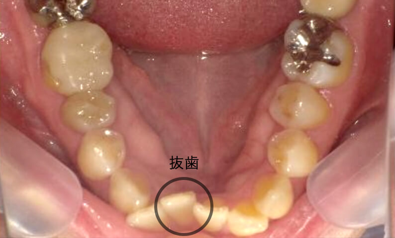 部分矯正 40代の症例写真