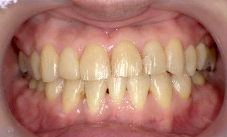 部分矯正 40代の症例写真